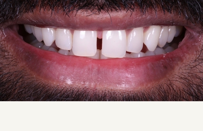 Before