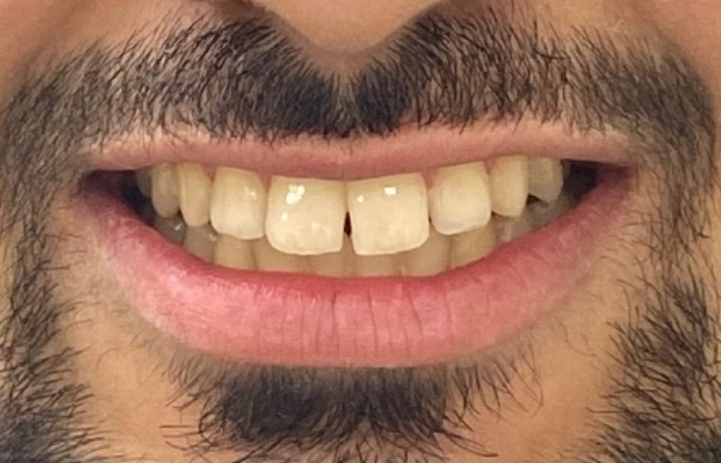 Before
